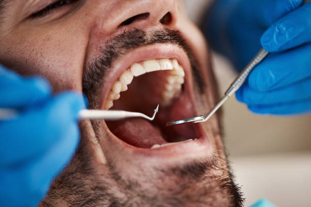 Best Emergency Wisdom Tooth Extraction in Untain View, MO